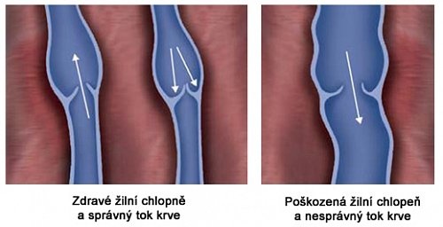 Žilní refux