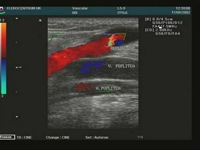 Ultrazvuk žilního refluxu